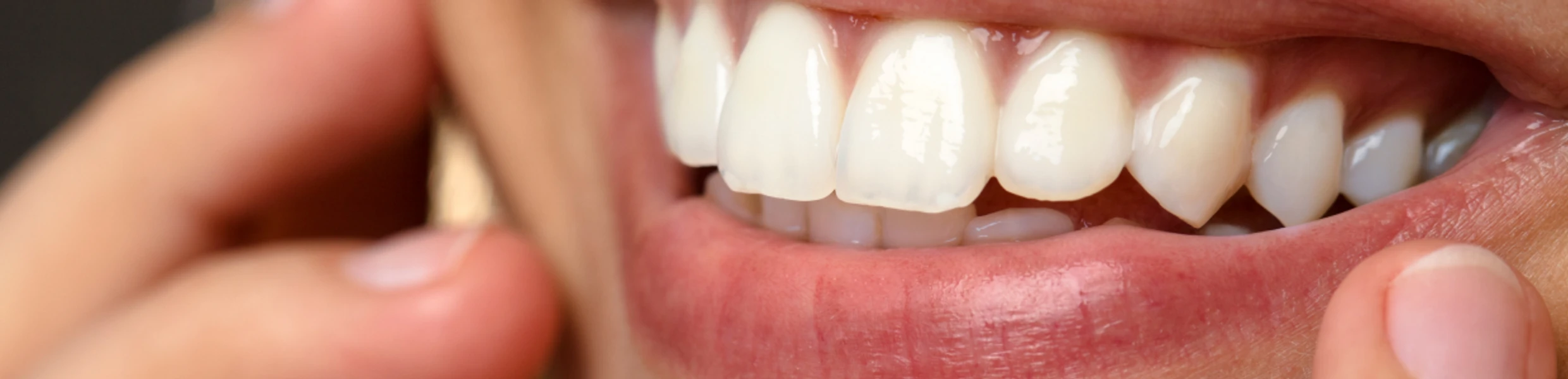 facettes ceramique restauration dentaire metz Facettes dentaires Dentistes à Metz | Esthétique dentaire | Cabinet dentaire des Ormes