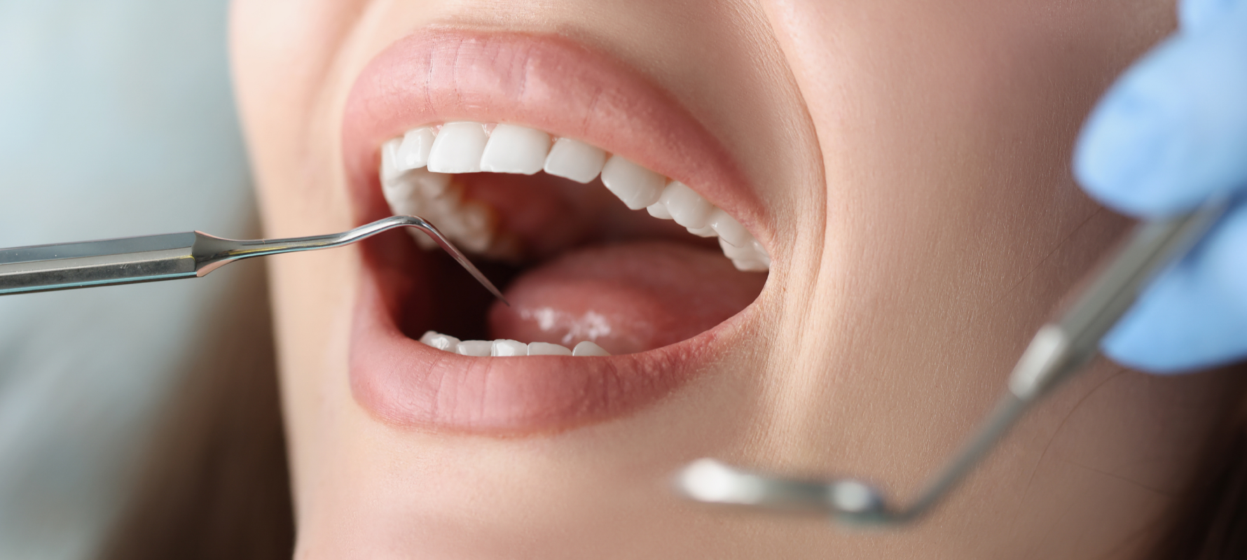 adobestock Éclaircissement dentaire Dentistes à Metz | Esthétique dentaire | Cabinet dentaire des Ormes