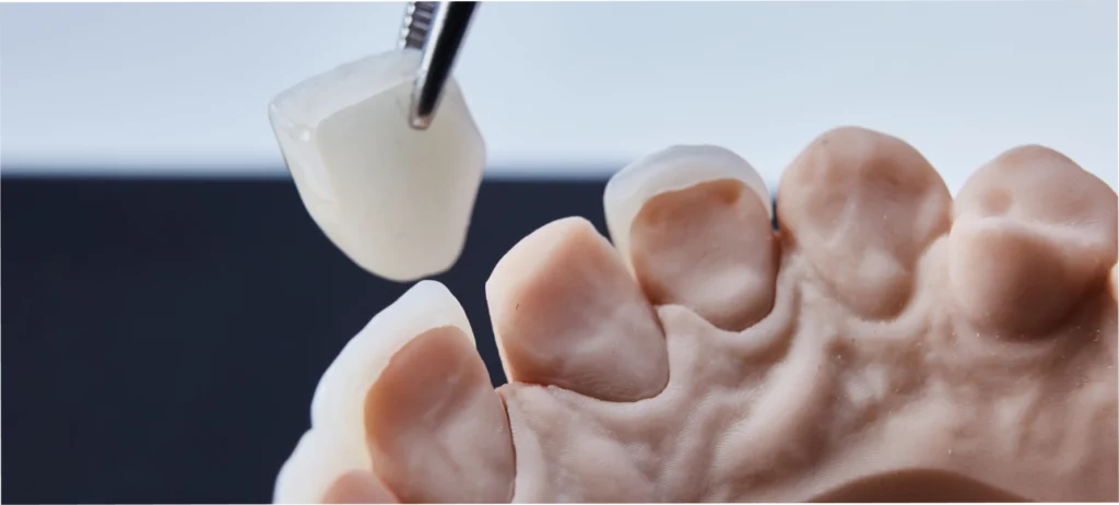 consultation dentiste facettes metz Facettes dentaires Dentistes à Metz | Esthétique dentaire | Cabinet dentaire des Ormes