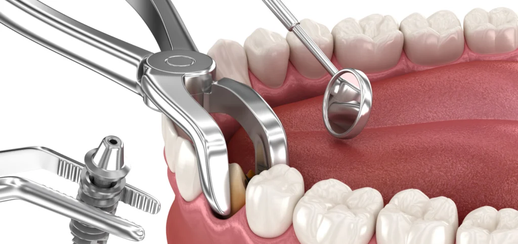 extraction implantation metz Chirurgie orale Dentistes à Metz | Esthétique dentaire | Cabinet dentaire des Ormes