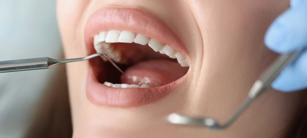 Parodontite : la maladie des gencives