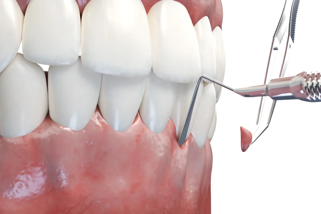 soins gencives chirurgicaux metz Soins des gencives chirurgicaux Dentistes à Metz | Esthétique dentaire | Cabinet dentaire des Ormes